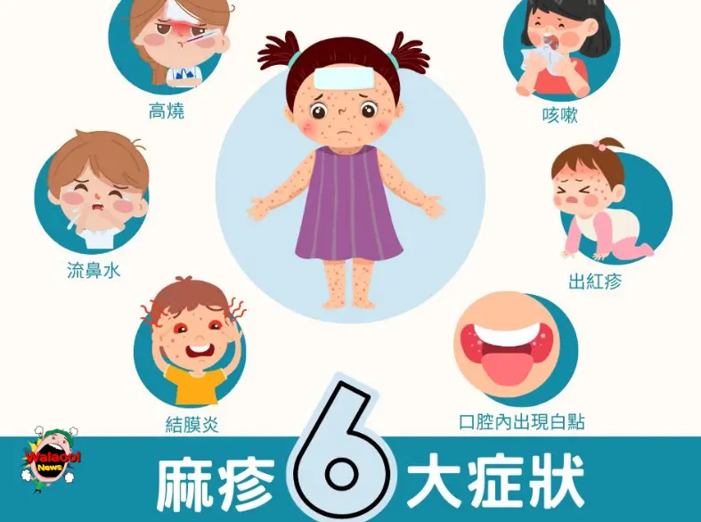 麻疹六大症状包括高烧、咳嗽、流鼻水和结膜炎等